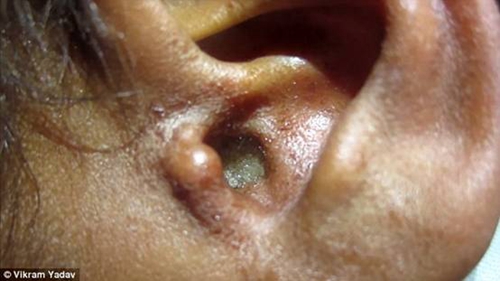 男子熟睡耳朵被苍蝇入侵医生从中取出近百只蛆(图)健康卫生频道
