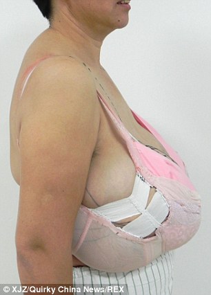 五旬妇女深受巨胸困扰手术切除6公斤重获C罩杯健康卫生频道