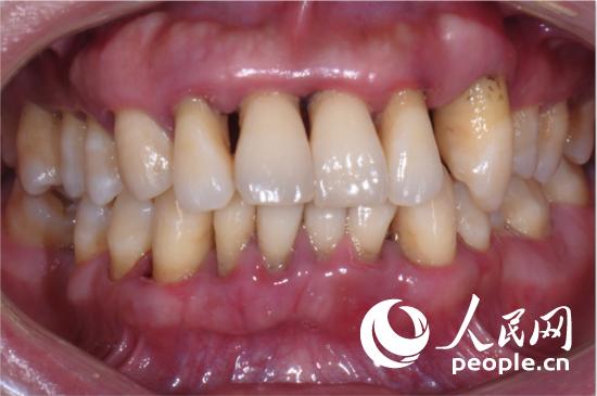 专家为你讲解牙周炎的症状、预防和治疗方法-