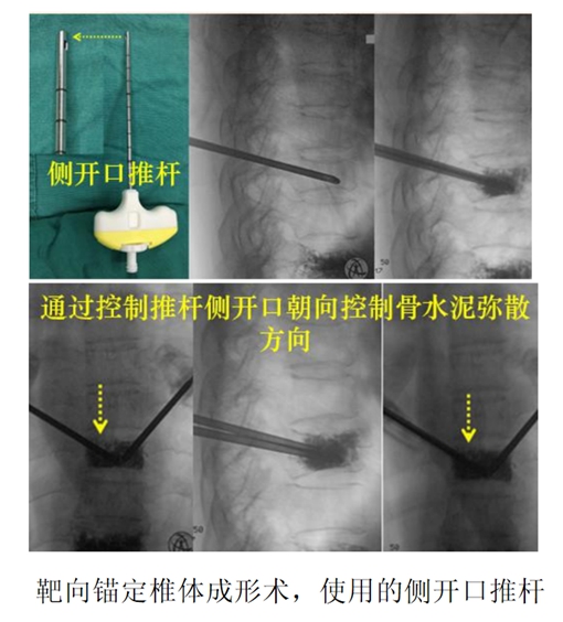 广州中医药大学第一附属医院：“挺直脊梁、不断向前”的脊柱骨科